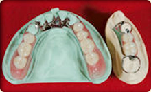 入れ歯の一例　コバルトクロム床