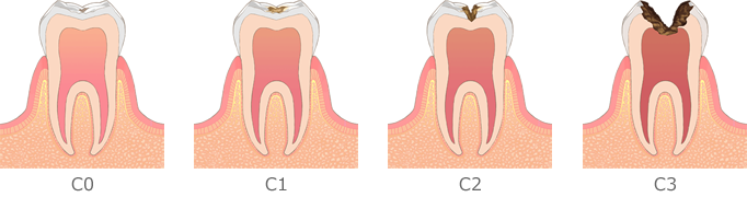 むし歯の治療について