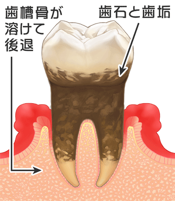歯周炎（歯周病が進んできた段階）