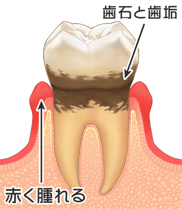 歯肉炎（歯周病が軽度の段階）