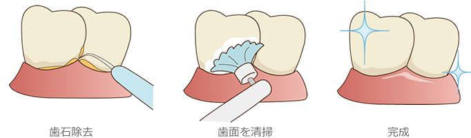 歯のクリーニング/pmtc